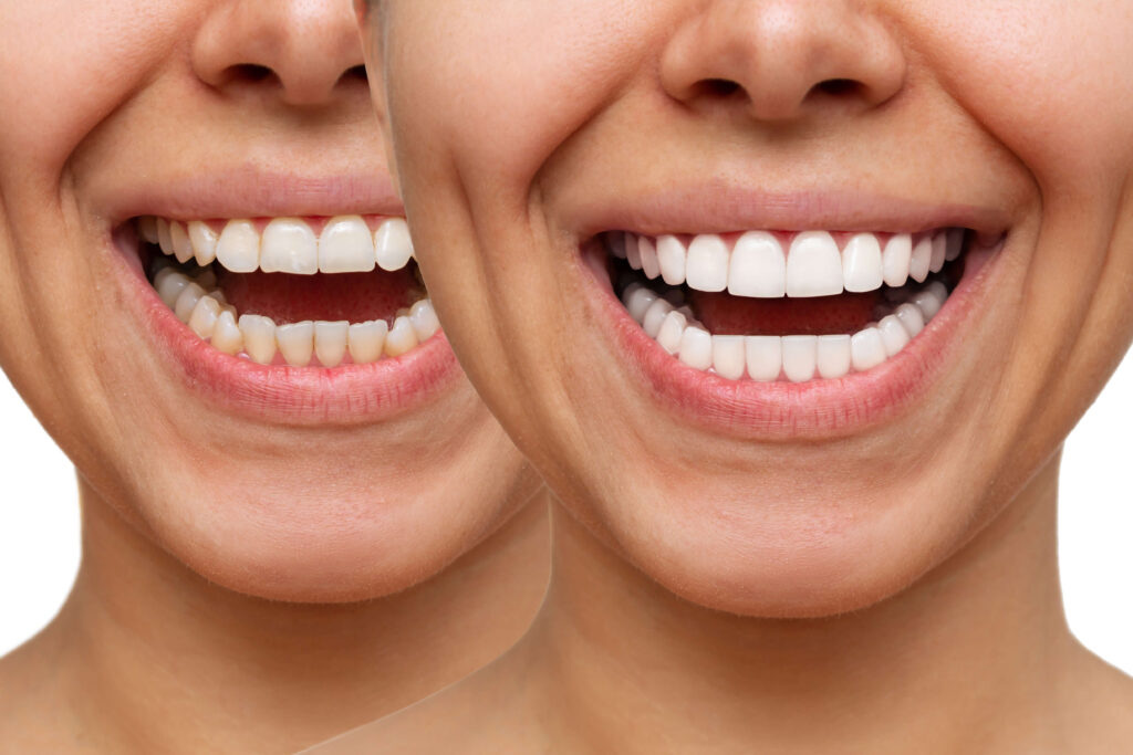 the Improved Zirconia Crowns Before and After